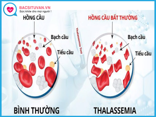 Tổng quan về bệnh thiếu máu do beta thalassaemia